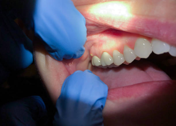 Best Emergency Root Canal Treatment in Fort Hunt, VA